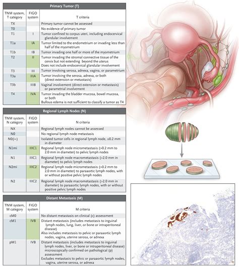 Endometrial Cancer Symptoms Staging Treatment And Causes Riset