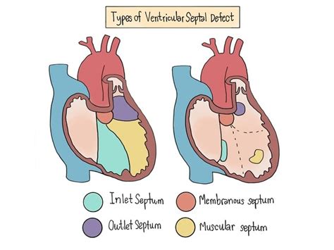 patofisiologi ventricular septal defect alomedika