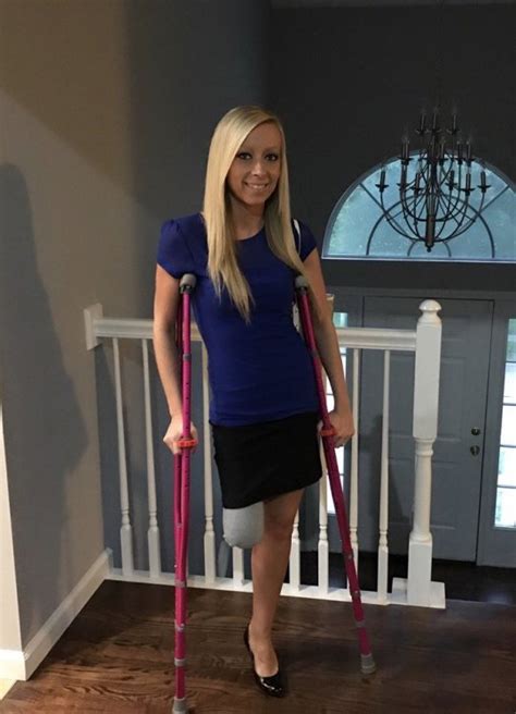 woman whose leg stopped growing says amputation gave her a new lease of life metro news