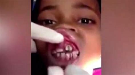 video shows  maggots  removed  schoolgirls gums newscomau australias leading