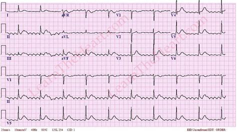 Ecg Atrial Flutter With Advanced Atrioventricular Block And Left My