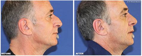 Nose Job Rhinoplasty For Men Our Team Of Surgeons