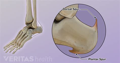 The 2 Common Types Of Heel Spurs