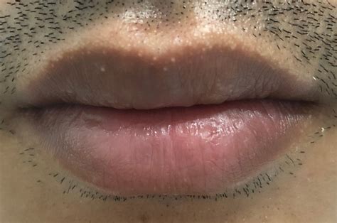 hpv warts lip pictures