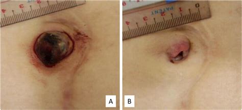 a 18f fluoro deoxyglucose positron emission tomography