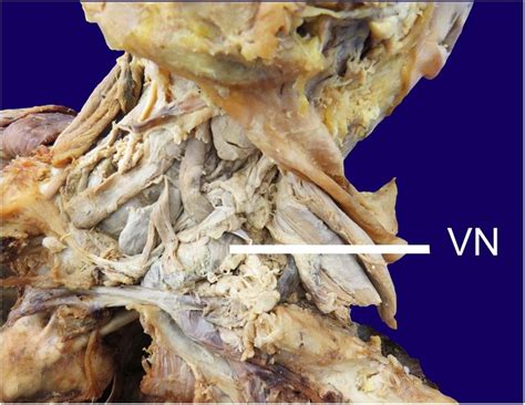 troisier sign and virchow node the anatomy and pathology of pulmonary