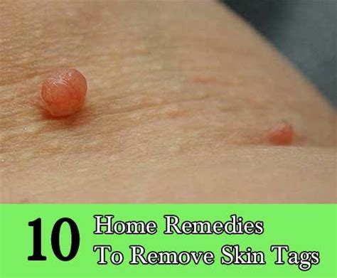 10 home remedies to remove skin tags home and gardening ideas