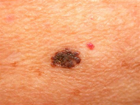 melanoma symptoms staging treatment