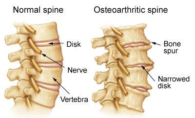 treatment  arthritis   neck  nj pain management doctor