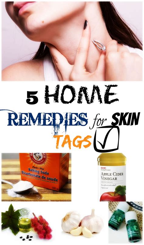 5 home remedies for skin tags daily beauty tricks home remedies for