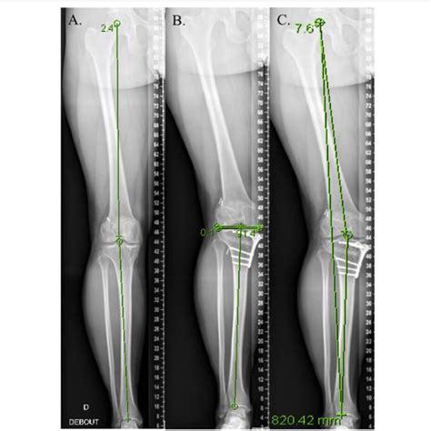 Managing Intra Articular Deformity In High Tibial Osteotomy A My Xxx