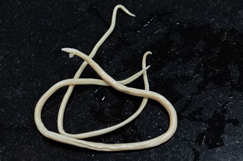 ascariasis is a disease caused by the parasitic roundworm ascaris