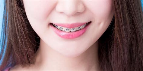 gusi bisa miring  pemakaian behel dentova official website