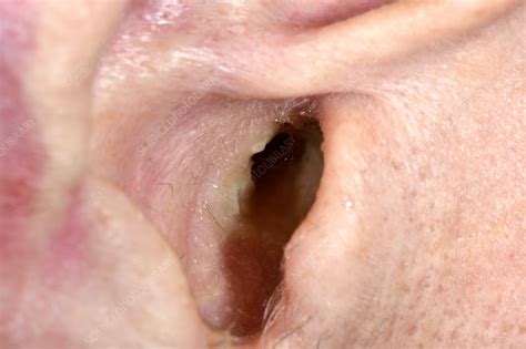 ear infection stock image  science photo library
