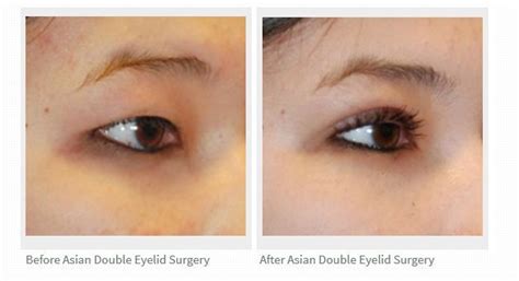 This Is A Before And After Of A Asian Double Eyelid Crese