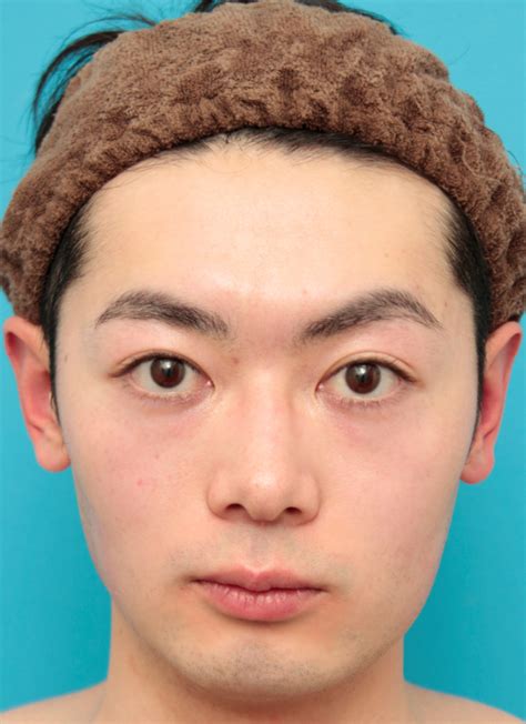 眉間~鼻筋にかけてのシリコンプロテーゼ ボツリヌストキシン注射（エラ、プチ小顔術）をした20代男性の症例写真 ： 美容整形の高須クリニック