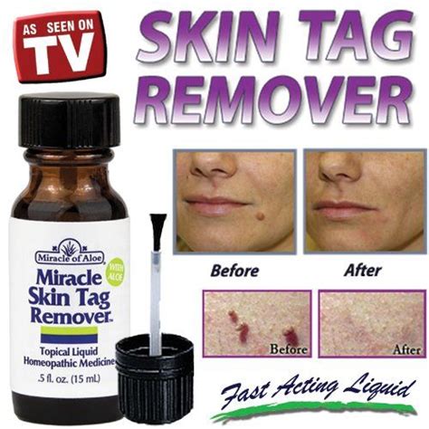 15 best skin tag removal products images on pinterest