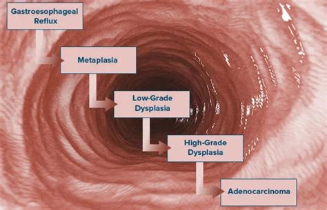 advanced esophageal cancer life expectancy canceroz