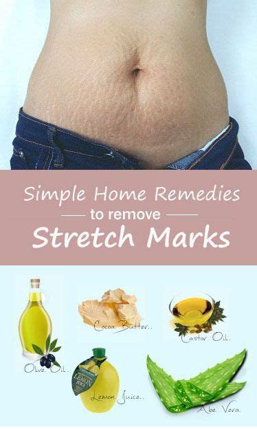 Get Rid Of Stretch Marks Naturally At Home Amazing Remedies Stretch