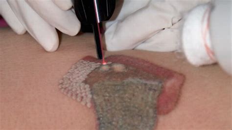 tattoo removal booms  slow job market abc news