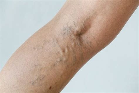 Natural Treatments For Varicose Veins — Step To Health