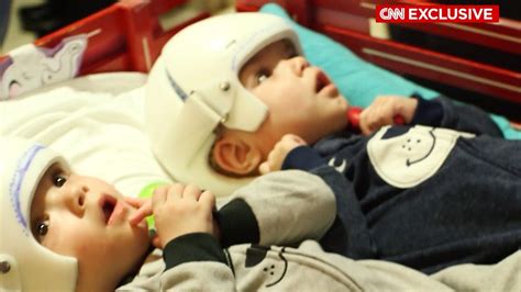 formerly conjoined twins leave hospital cnn video