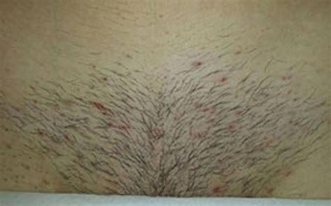 before and after hair removal results clhr