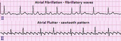 atrial fibrillation topic review learn  heart