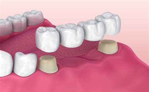 dental bridge aftercare scottsdale az