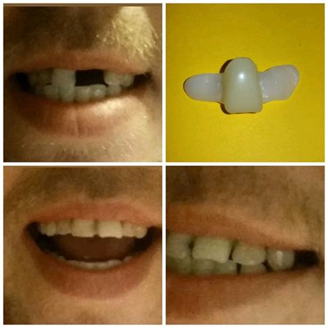 diy temporary replacement front tooth central incisor  oral care