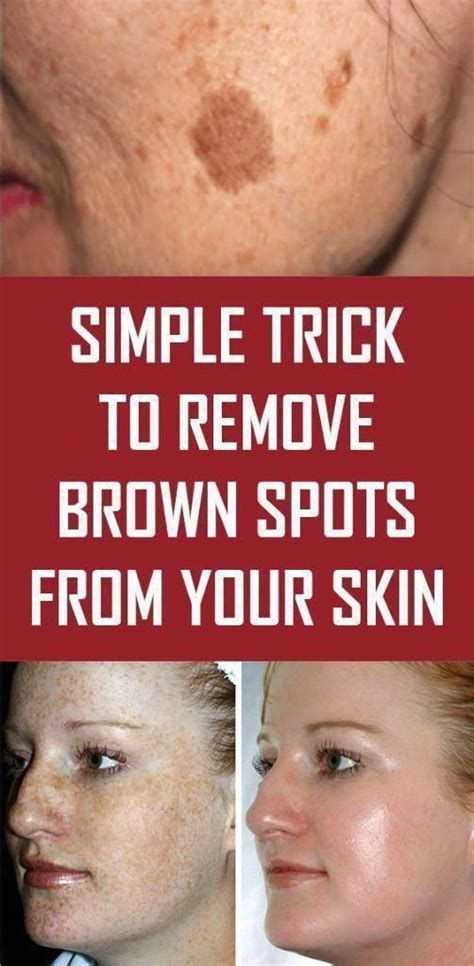 pin  natural    rid  brown spots  face