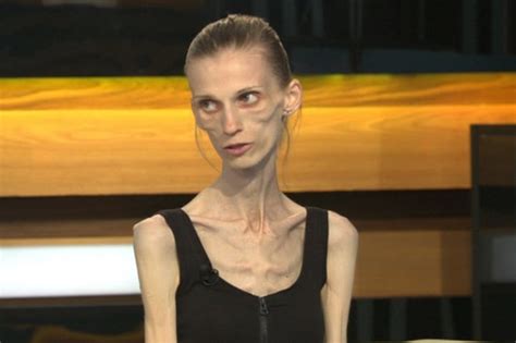 Anorexic Women Who Weighs Just Over Two Stone Will Die If