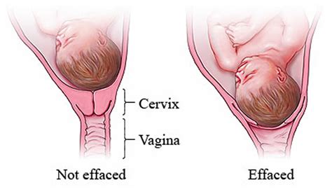 ways to help dilate and thin cervix guessuniversal