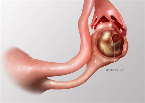ovarian cysts development  terrible complications