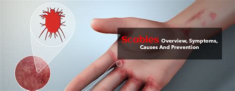 scabies overview symptoms causes and prevention kayawell