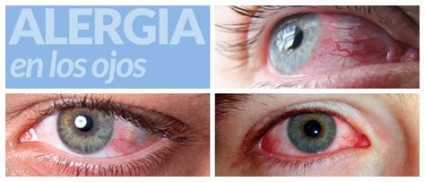 alergia en los ojos síntomas causas tipos diagnóstico tratamiento