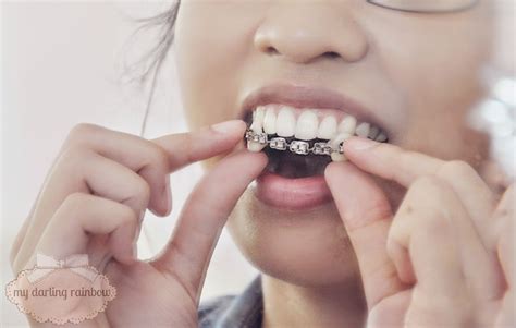 How To Make Homemade Fake Braces The Dangers Of Fake Braces Diy