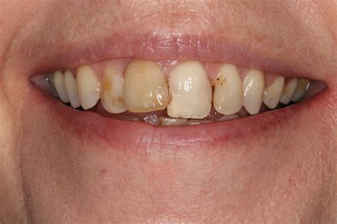 cosmetic braces   tooth whitening esthetique dental