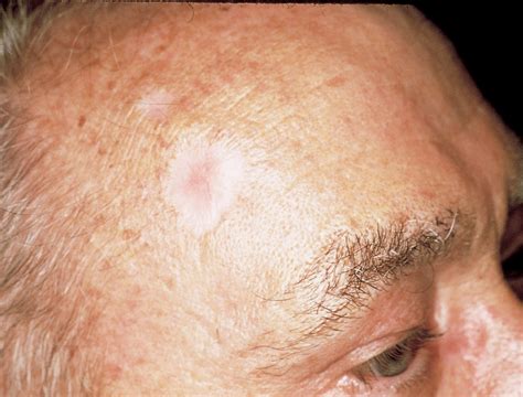 basal cell carcinoma warning signs and images the skin