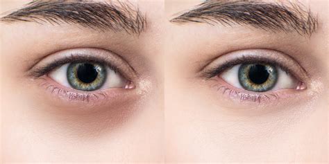 reasons   dark  eye circles   conceal  oxygenetix