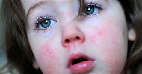 What Is Scarlet Fever And How Do You Get It Belfast Live