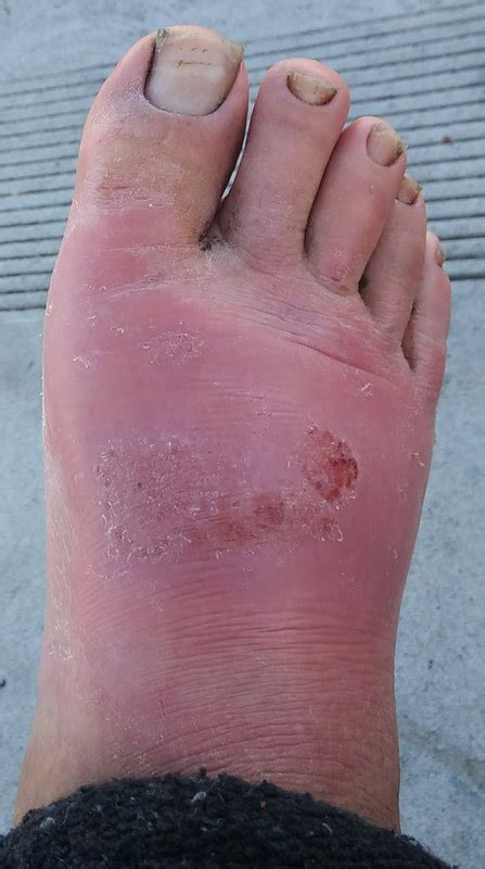 Athlete S Foot Feet And Jock Itch Rash Is Caused By Flesh Eating