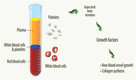platelet rich plasma prp therapy diversified integrated sports clinicdiversified integrated