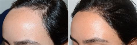Hair Transplants For Women Hairline Advancement Pictures Miami Fl