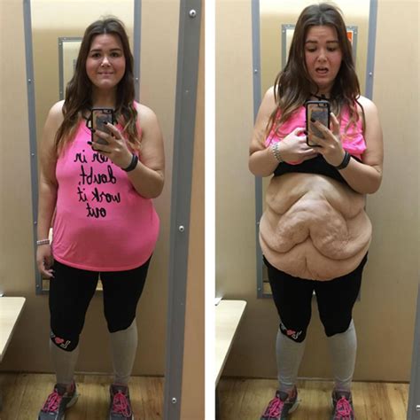 Woman Who Lost 185 Lbs Proudly Shows Off Excess Skin