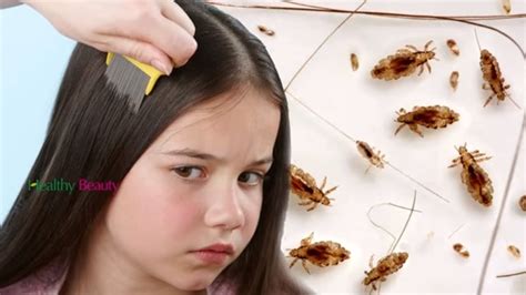how to get rid of head lice fast and easy health and beauty youtube