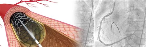 dr sharath reddy percutaneous coronary interventions complex