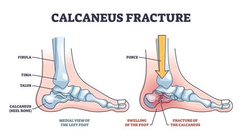 calcaneus fracture symptoms treatment   foot specialist