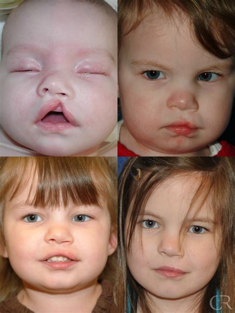 Cleft Lip And Palate Kentucky Center For Cosmetic