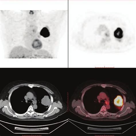 The Contrast Of Mediastinal Lymph Nodes Metastasis In Lung Cancer